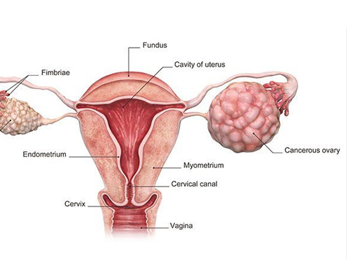 ovarian cancer