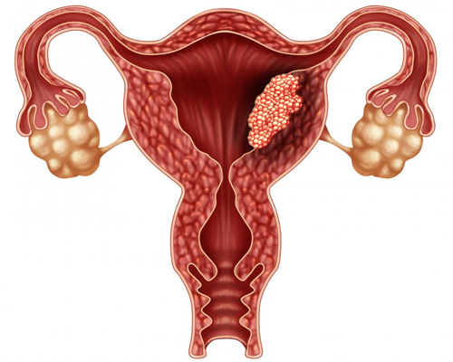 uterus cancer