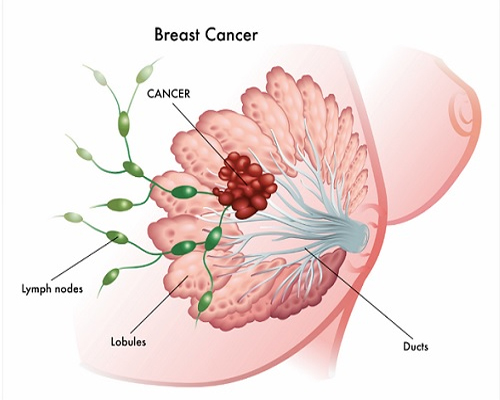 breast cancer