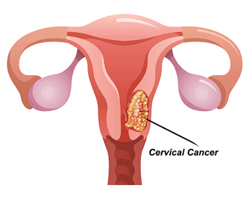 cervical cancer