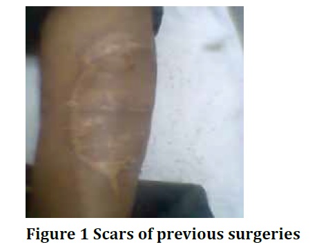 Dermatofibrosarcomaprotuberans