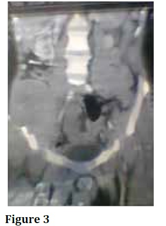 Dermatofibrosarcomaprotuberans