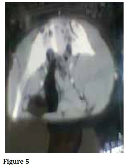 Dermatofibrosarcomaprotuberans