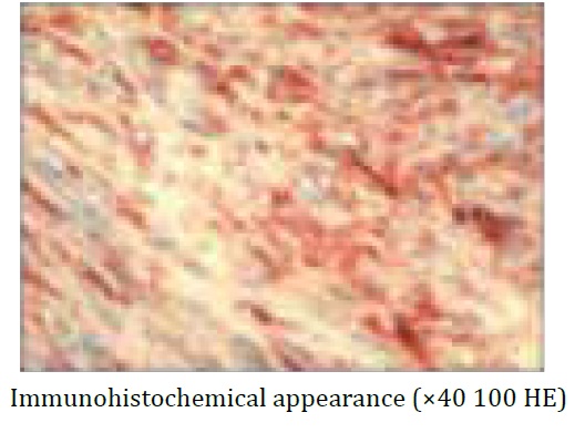 Dermatofibrosarcomaprotuberans