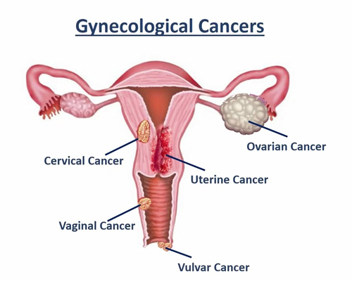gynecology cancer