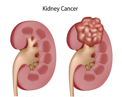 kidney cancer