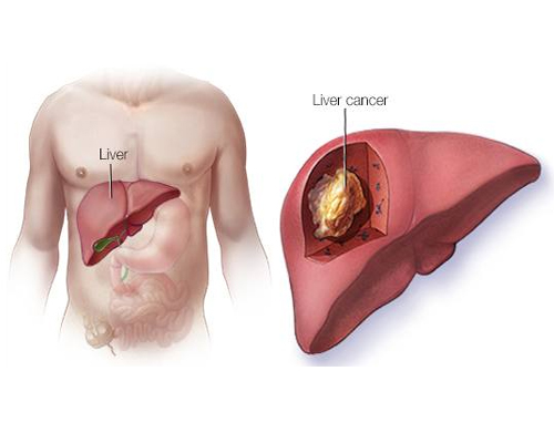 liver cancer