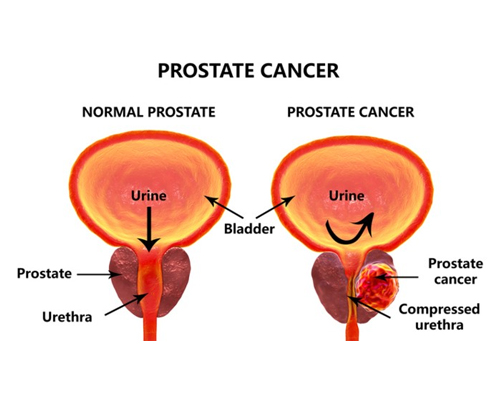 prostate cancer